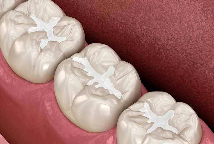 Dental sealants illustration